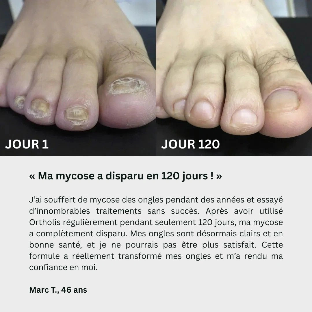 Gel contre les mycoses des ongles