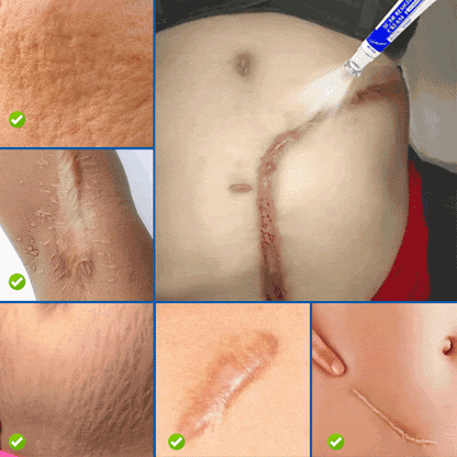 Crème Réparatrice Anti-Cicatrices et Vergeture