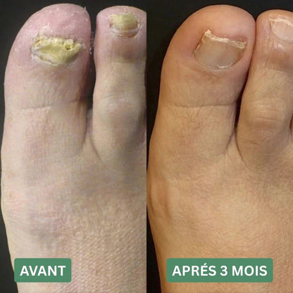 Gel contre les mycoses des ongles